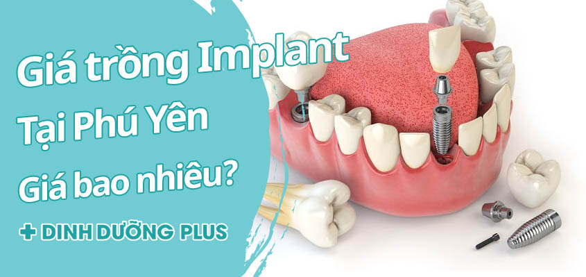 Trồng Implant tại Phú yên 1 lần hết bao nhiêu tiền?