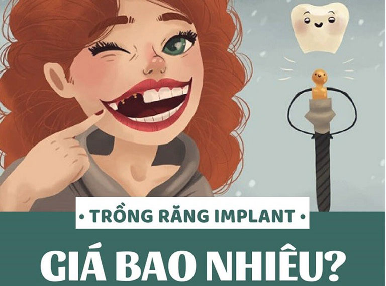 Giá ghép Implant tại Pleiku, Gia Lai 1 lần là bao nhiêu?