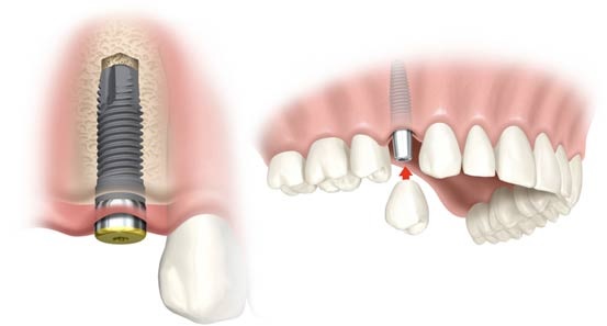 Trồng răng Implant Hội An giá bao nhiêu?