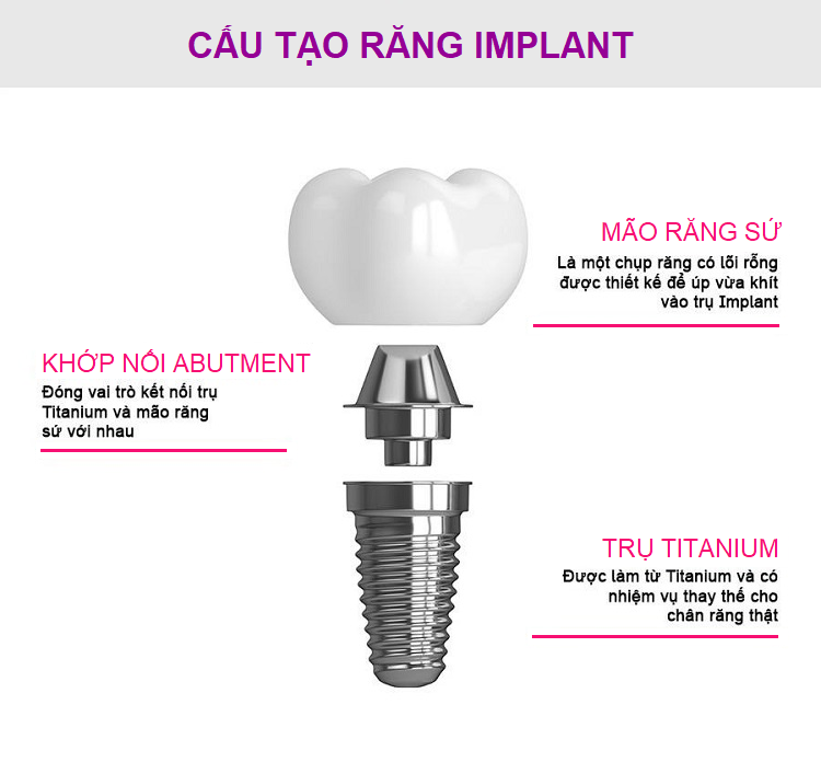Trồng răng Implant Hội An giá bao nhiêu?