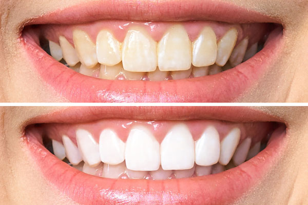 Giá tẩy trắng răng tại BMT