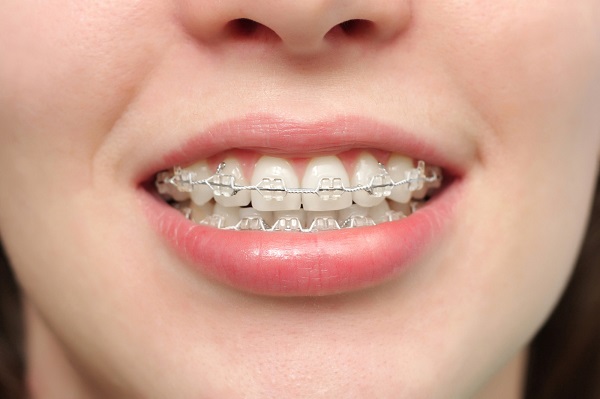 Niềng răng mắc cài tại BMT