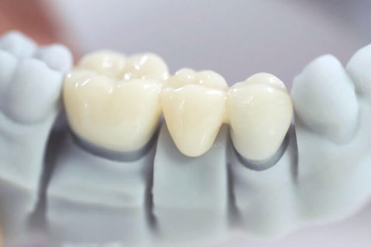 Bọc răng sứ tại BMT