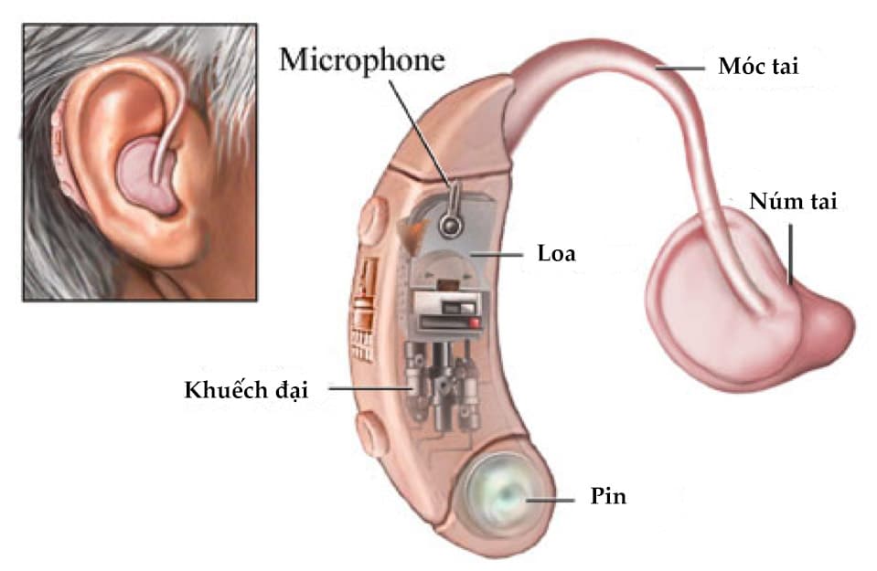 máy trợ thính tại Đông Hà, Quảng Trị 1