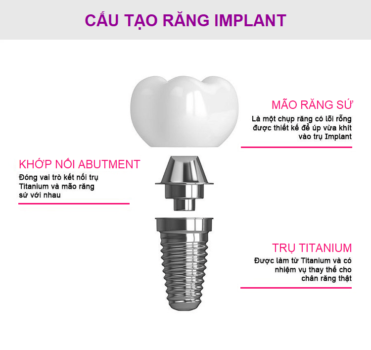 Giá ghép Implant tại Pleiku, Gia Lai là bao nhiêu?